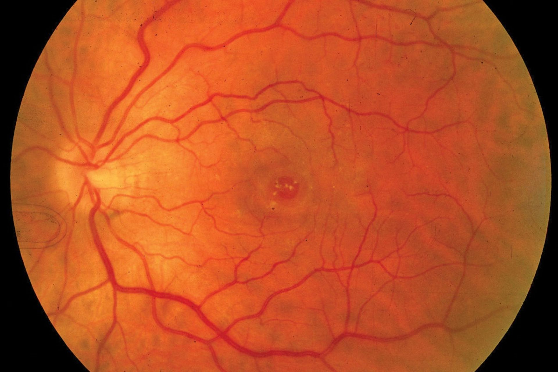 سوراخ ماکولا و تاری دید