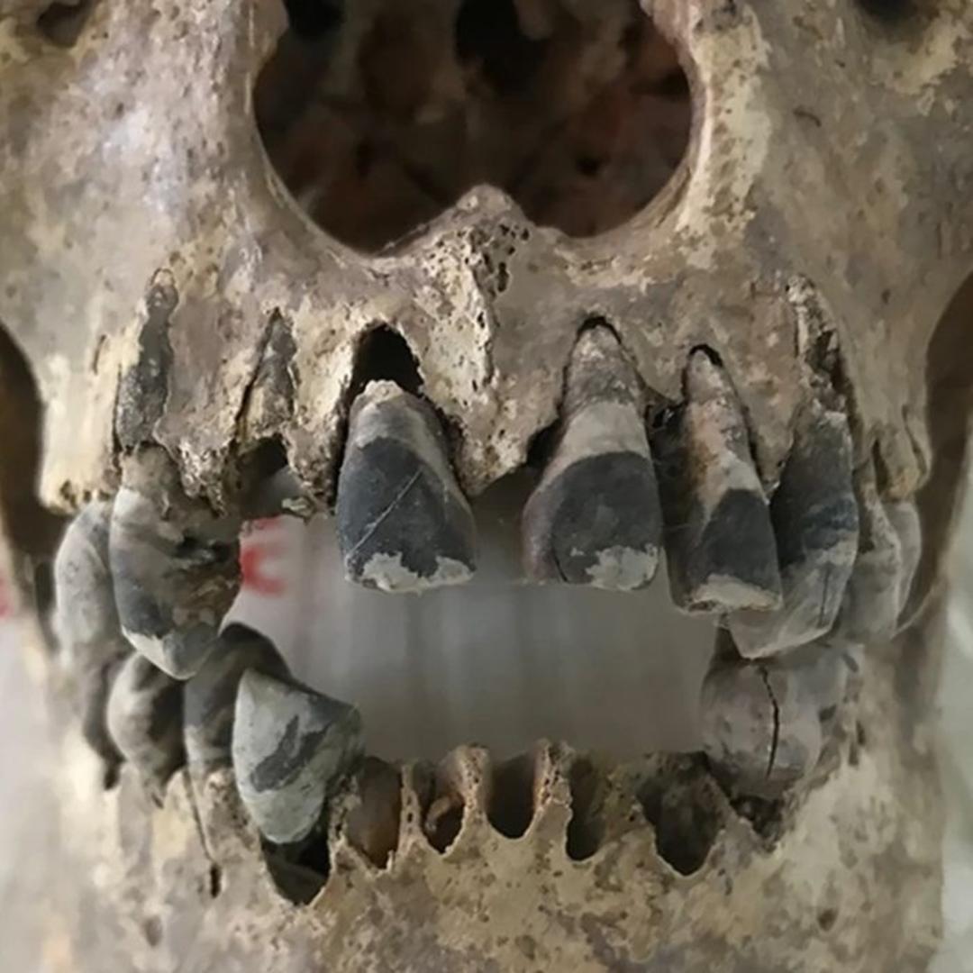 جمجمه‌ای ۲۰۰۰ ساله متعلق به محوطه باستانی «دونگ زا» در ویتنام، لایه‌ای از رنگ‌دانه‌های سیاه را روی دندان‌ها نشان می‌دهد.