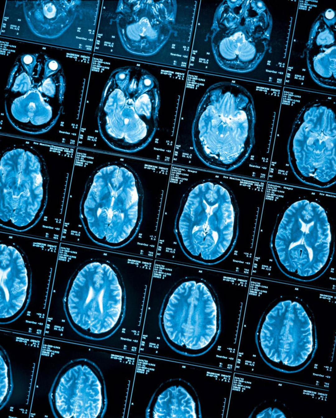 brain scan