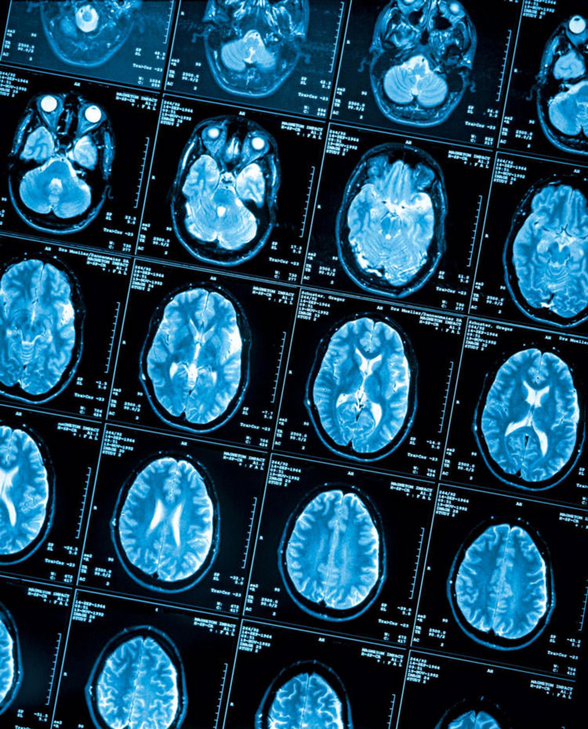 brain scan