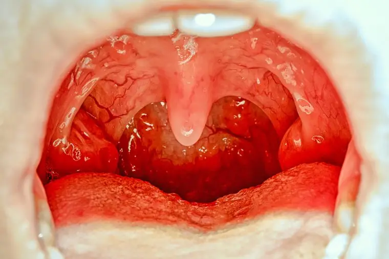 زبان کوچک / Uvula