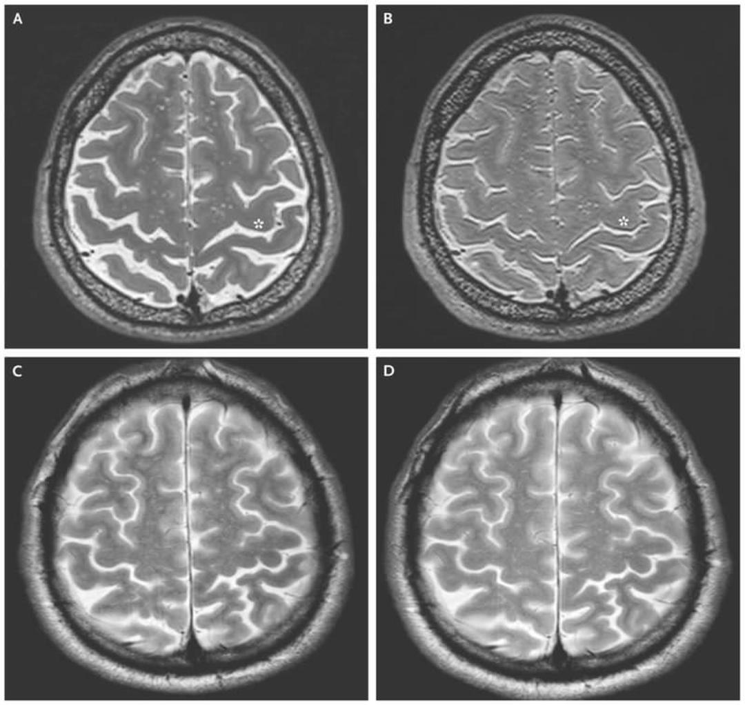 اسکن مغز فضانوردان / Astronauts Brain Scan