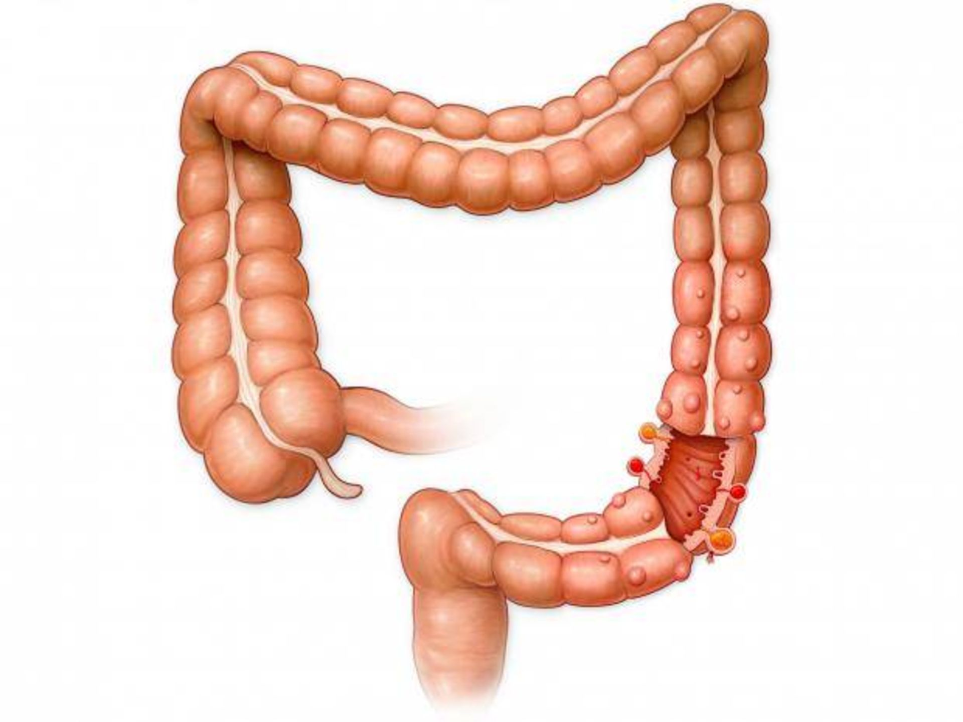 آپاندیس / Appendix