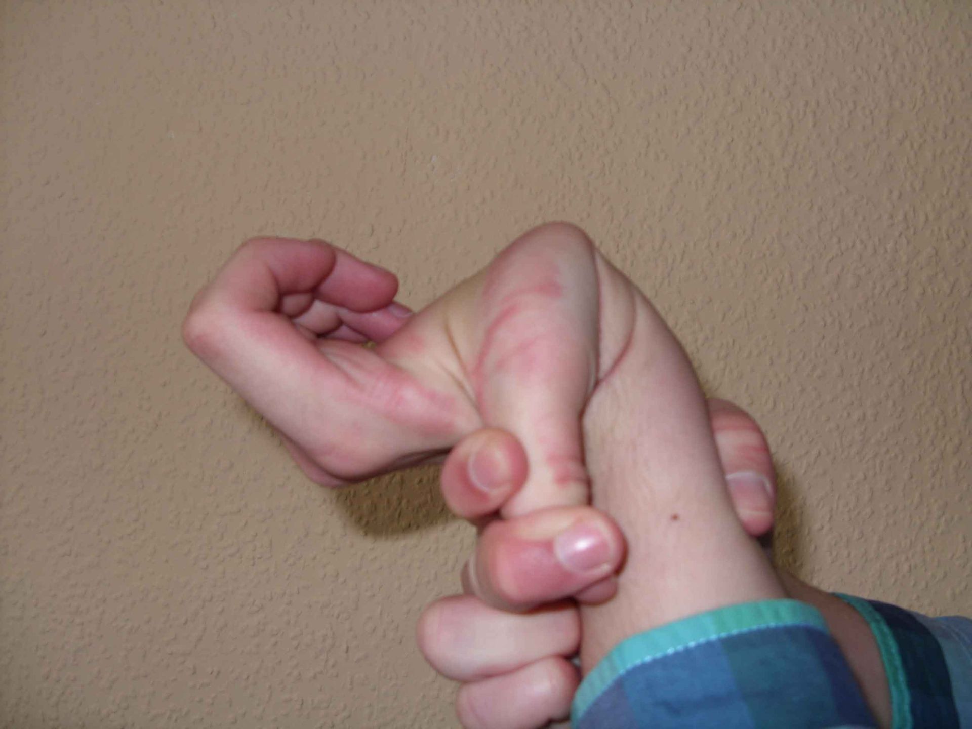 مفصل کاذب / double-jointed