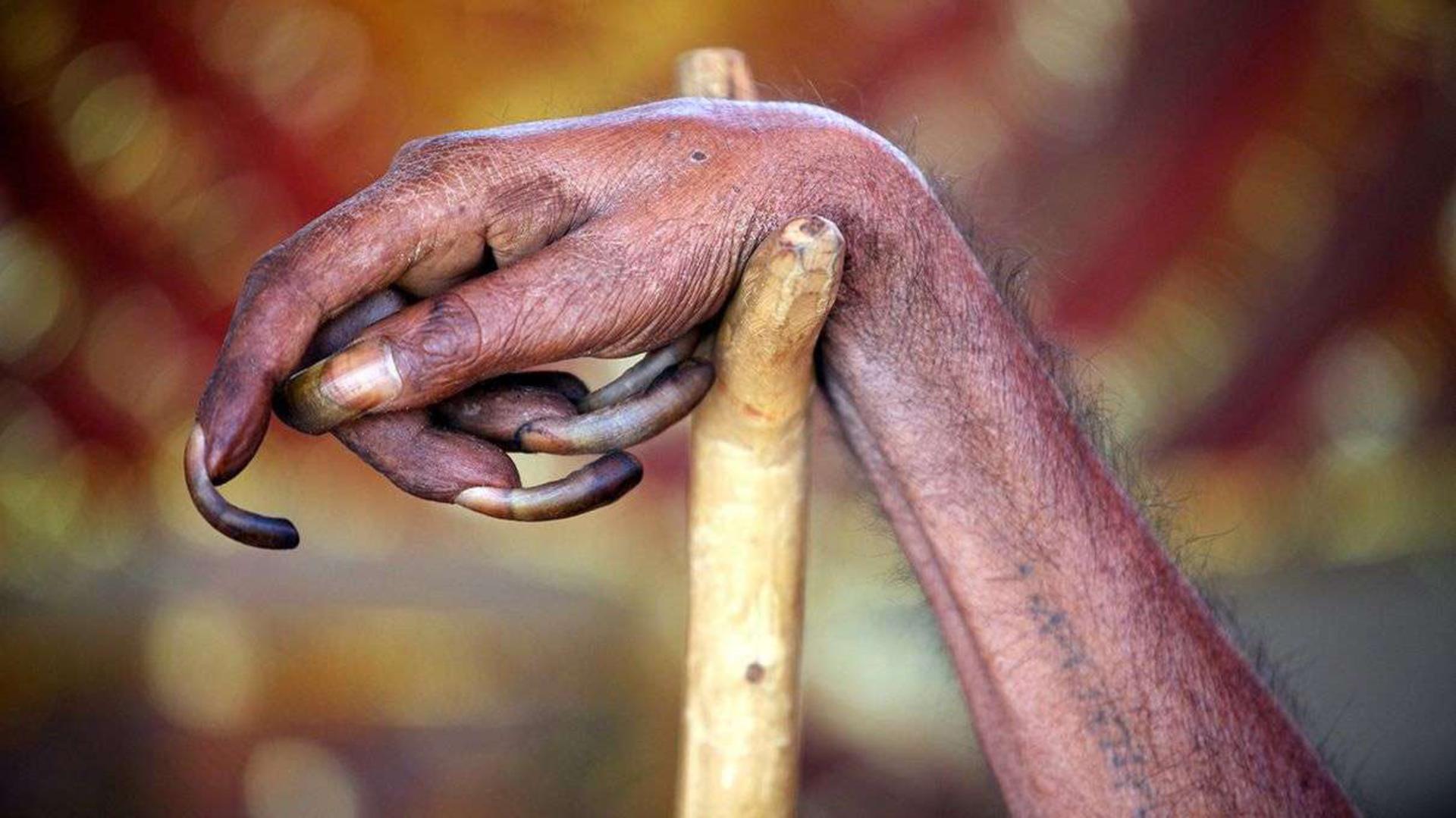 رشد ناخن‌ها /  Fingernails grow