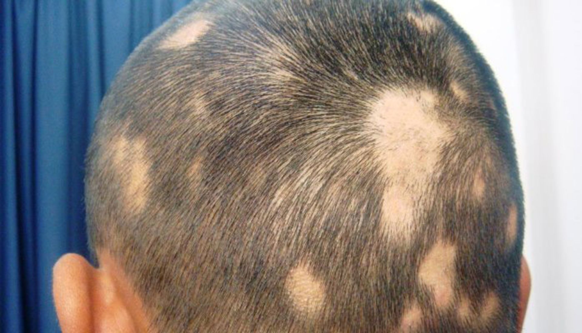 alopecia