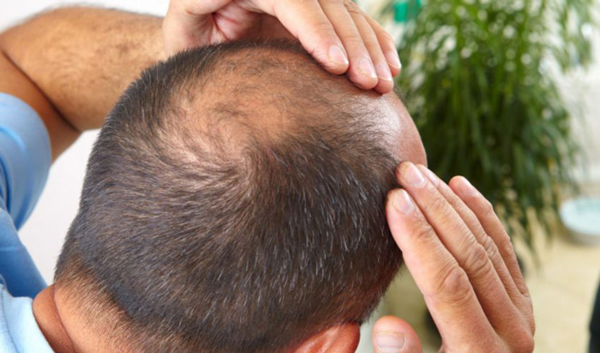 طاسی مو / hair bald