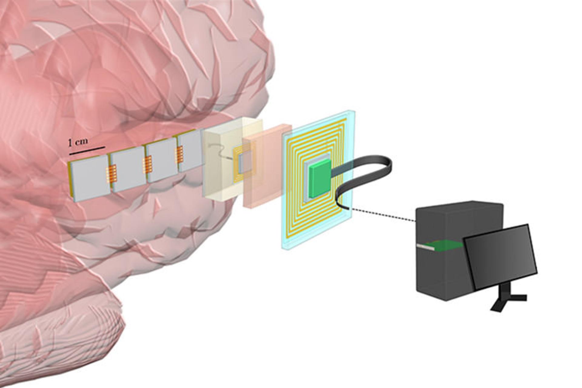 neuro implant