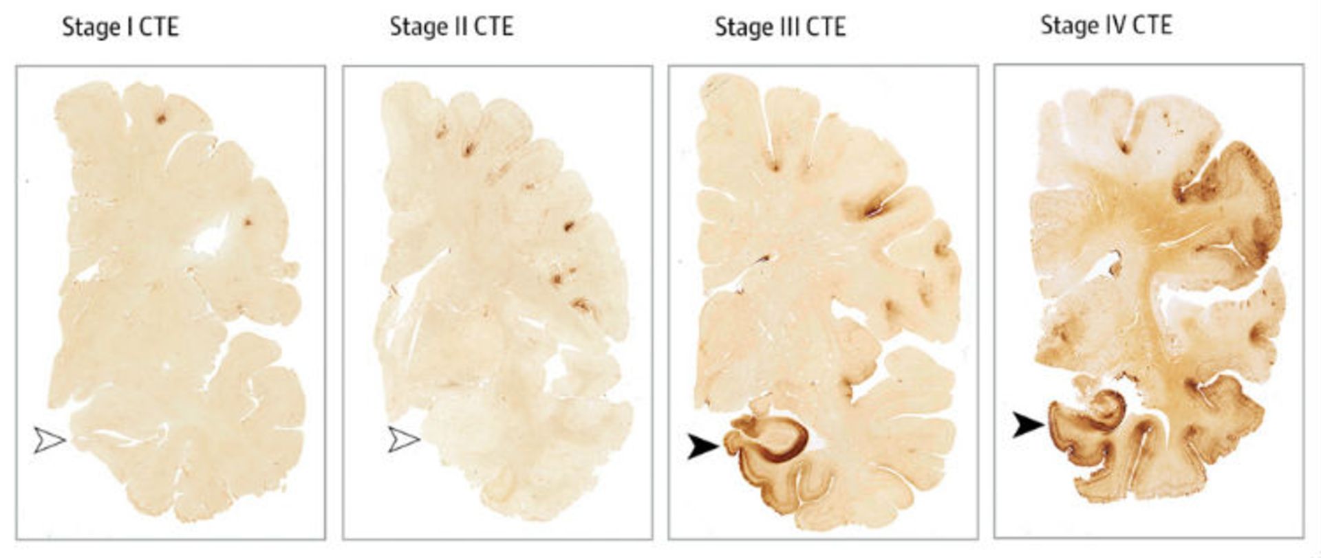 CTE