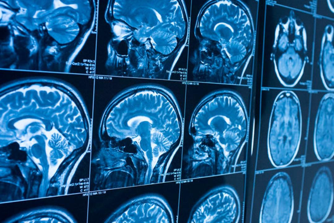 Brain Scanes