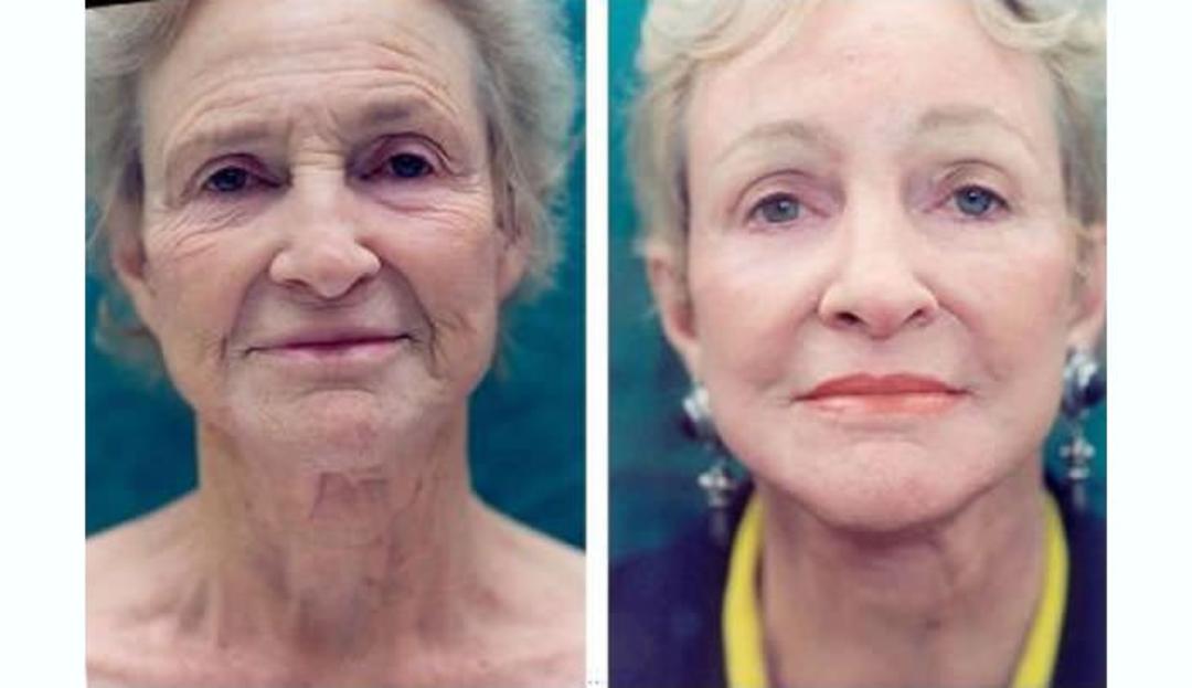 facial yoga