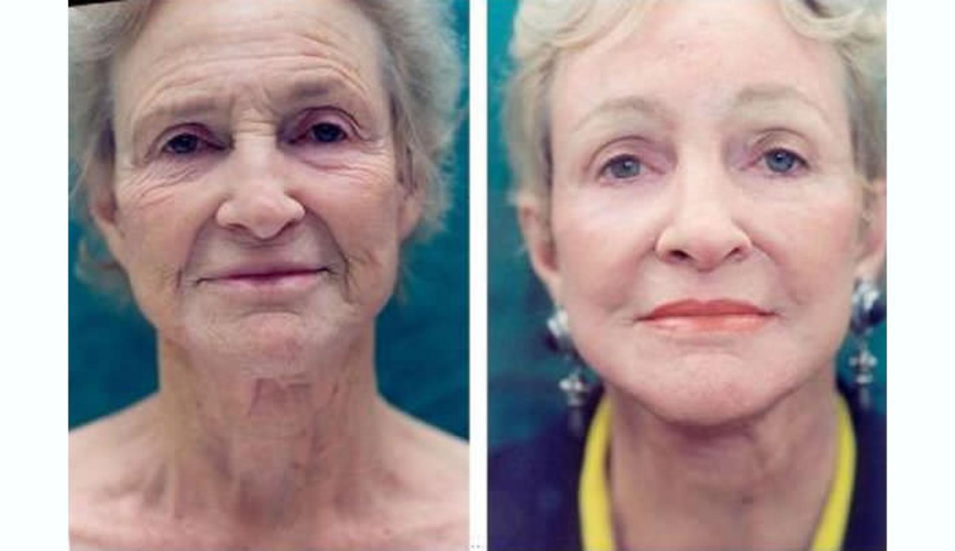 facial yoga