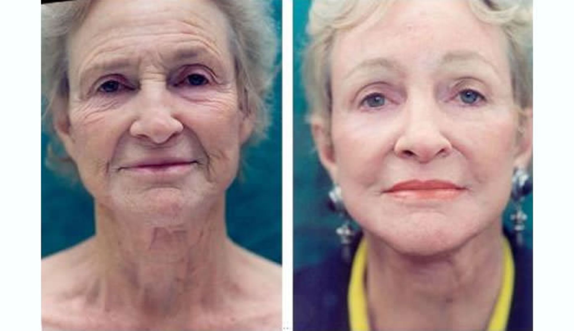 facial yoga