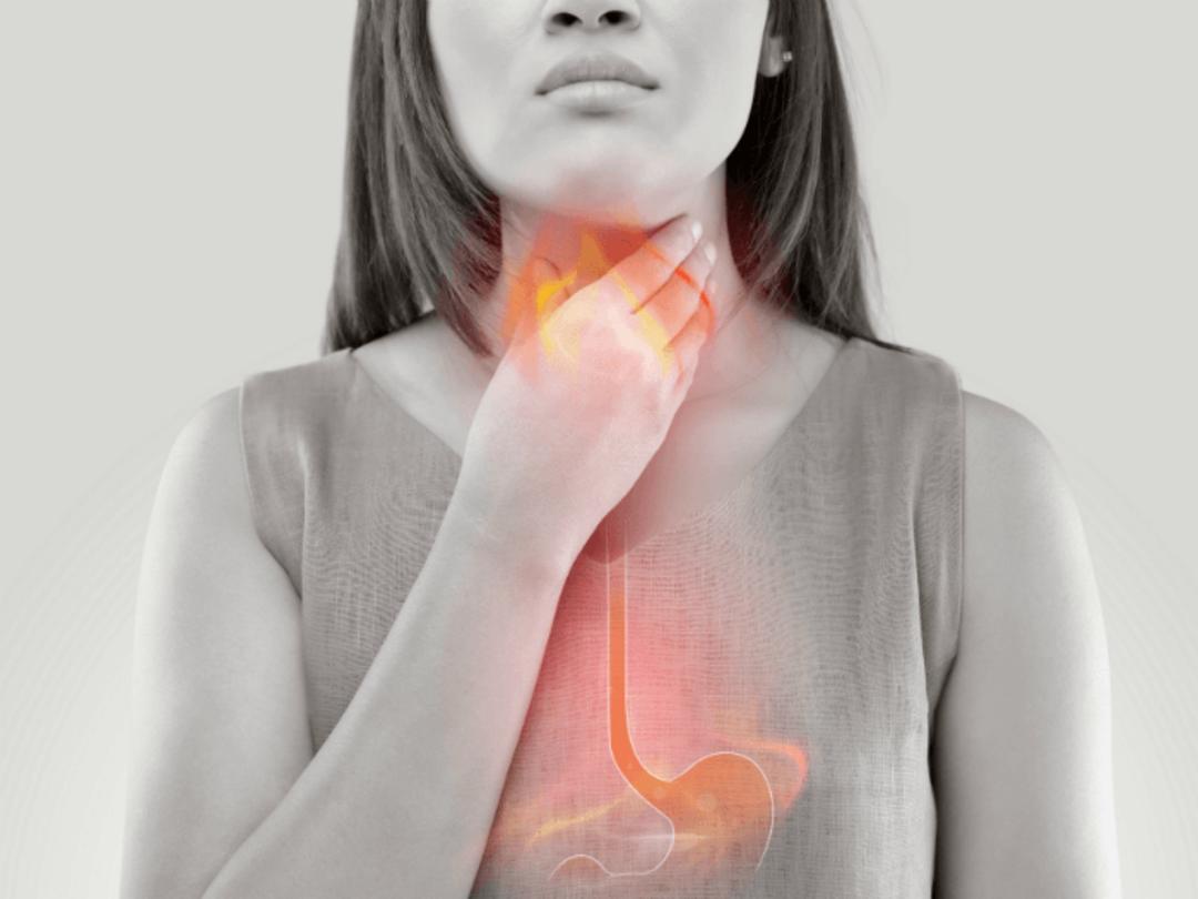Acid Reflux