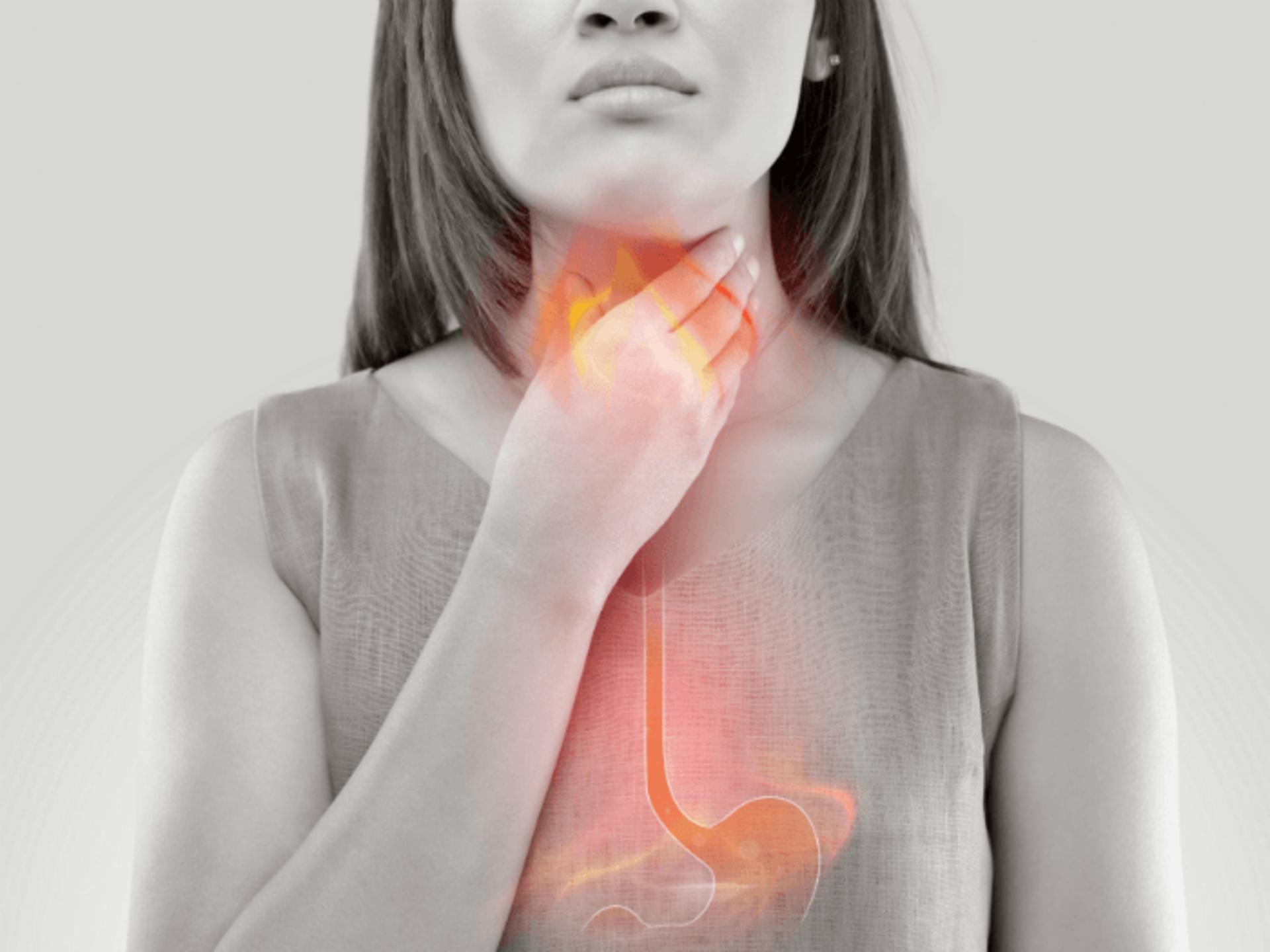 Acid Reflux