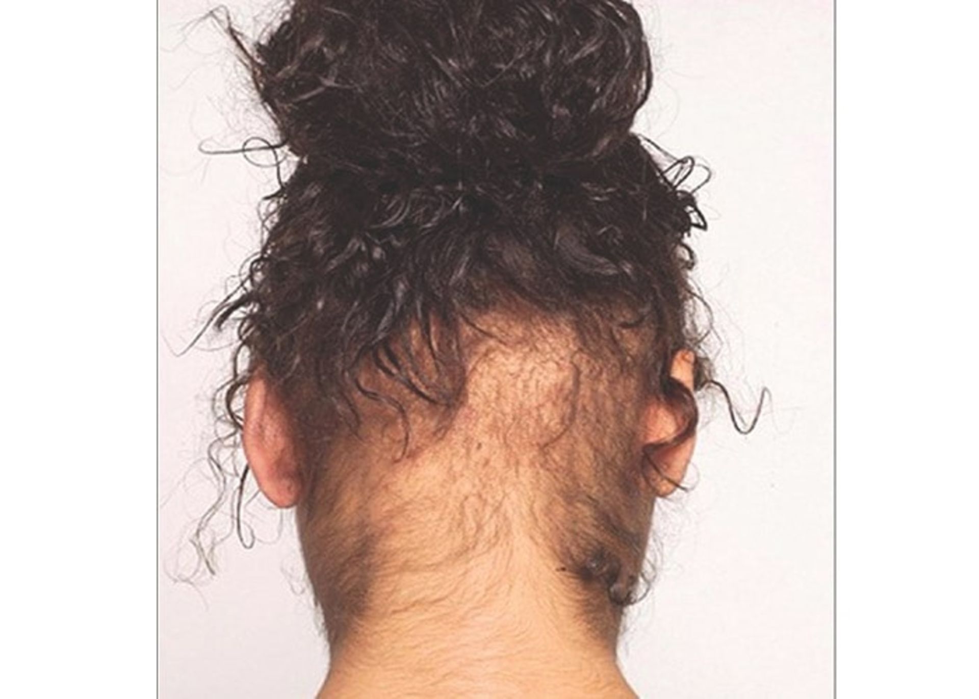 ریزش مو در اثر کشش