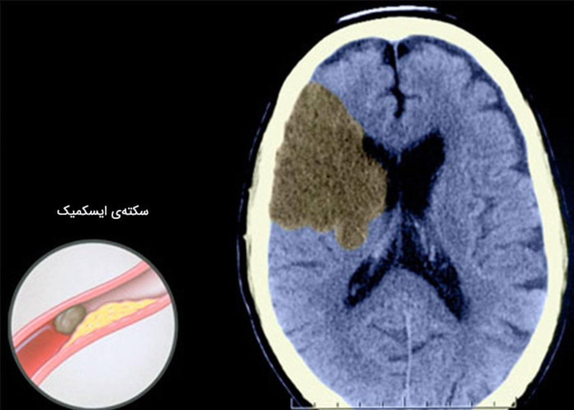 سکته ایسکمیک