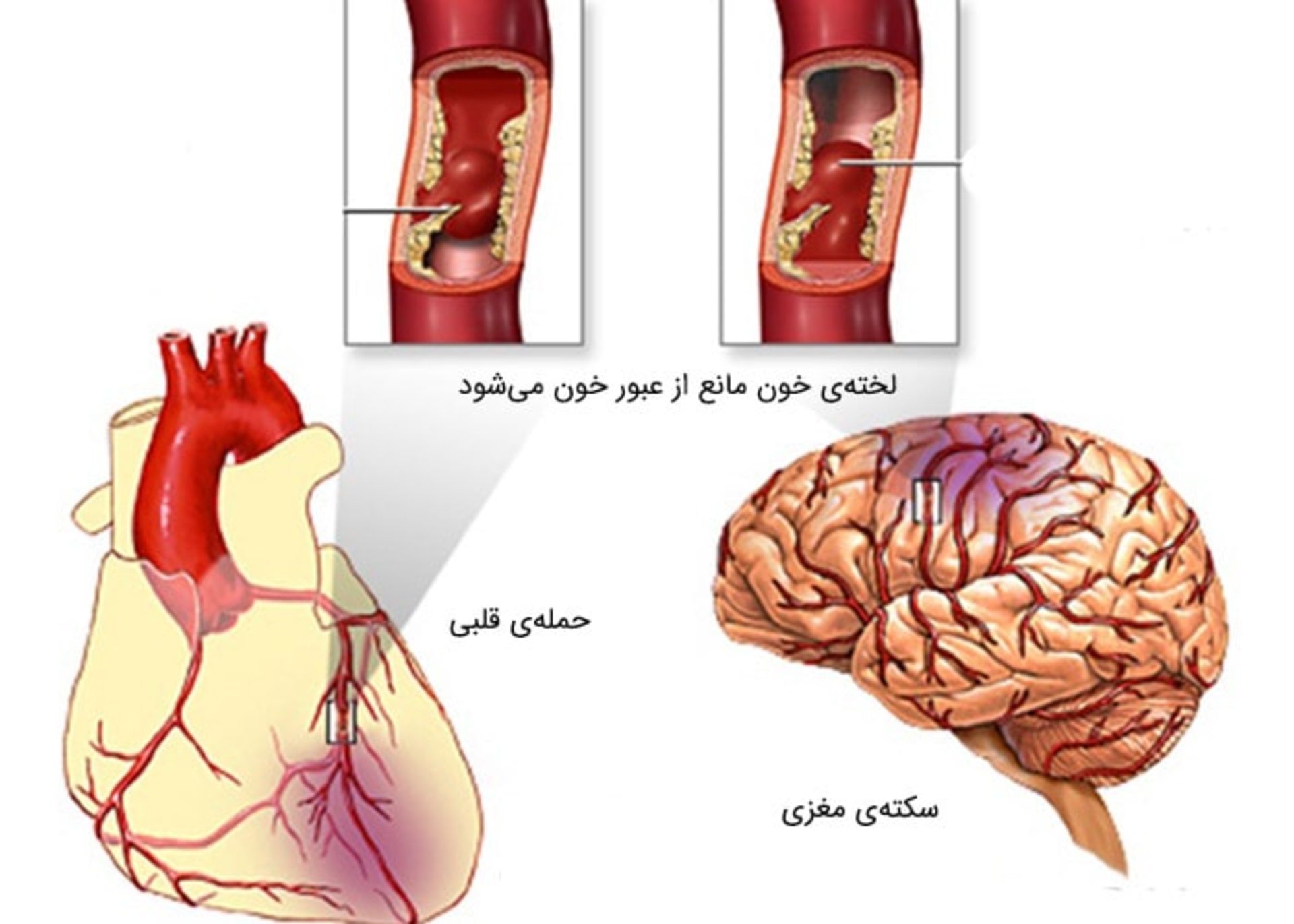 سکته و حمله قلبی