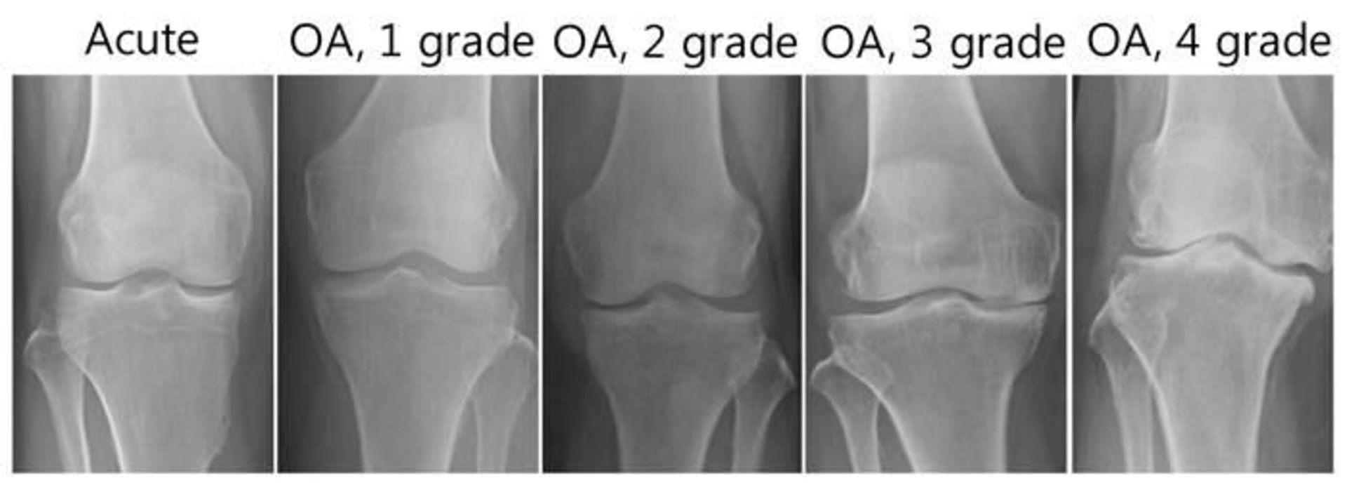 آرتروز/osteoarthritis