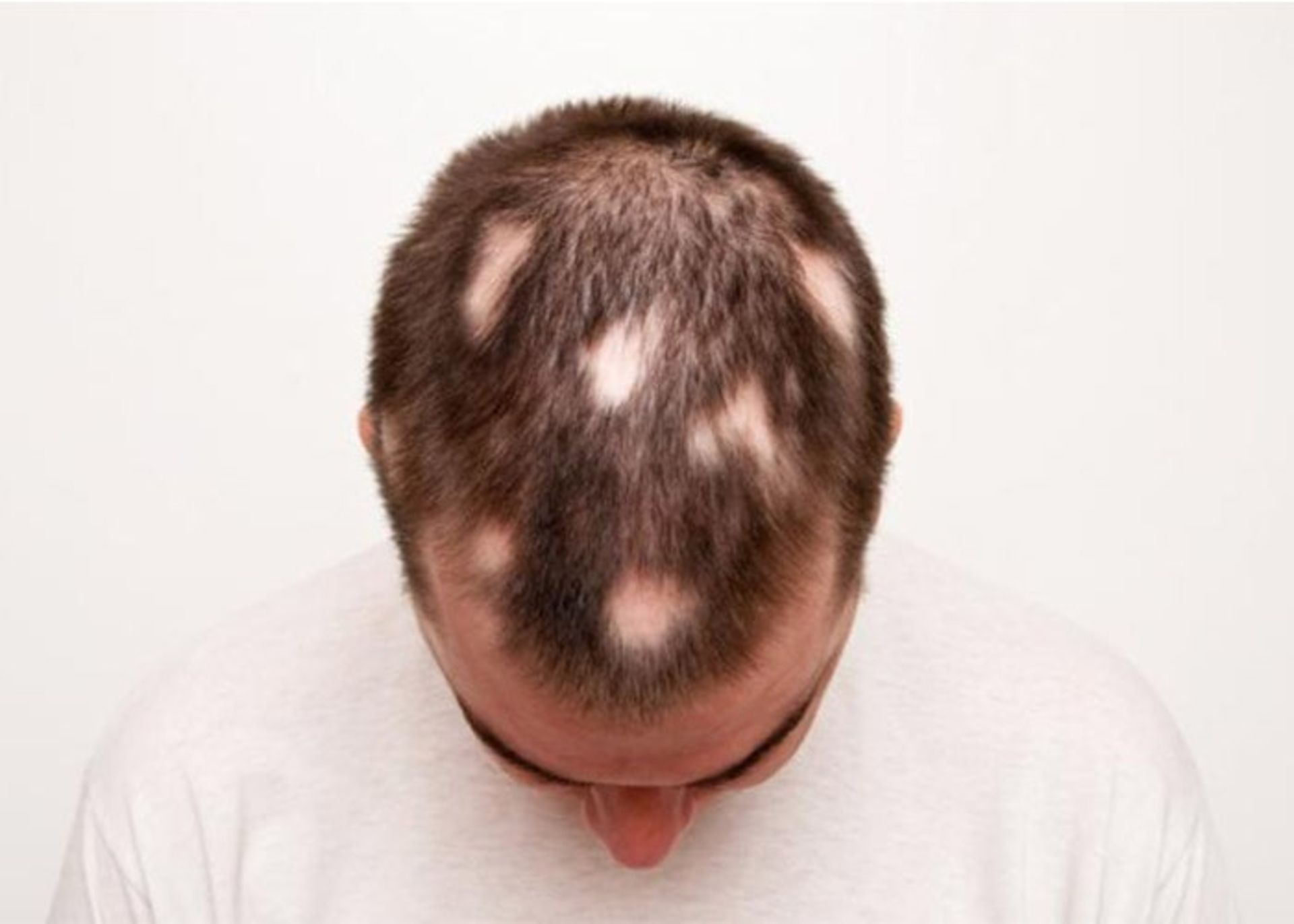 آلوپسی منطقه ای