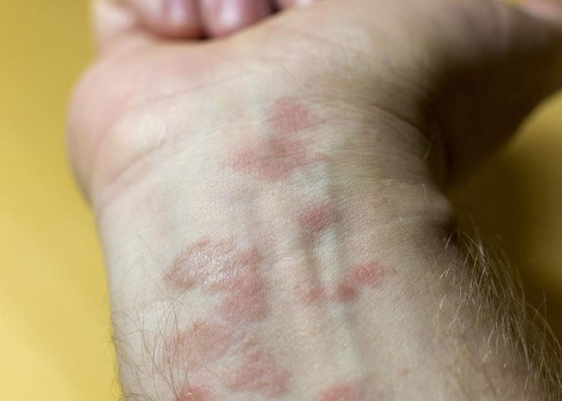 آگزمای آلرژیک