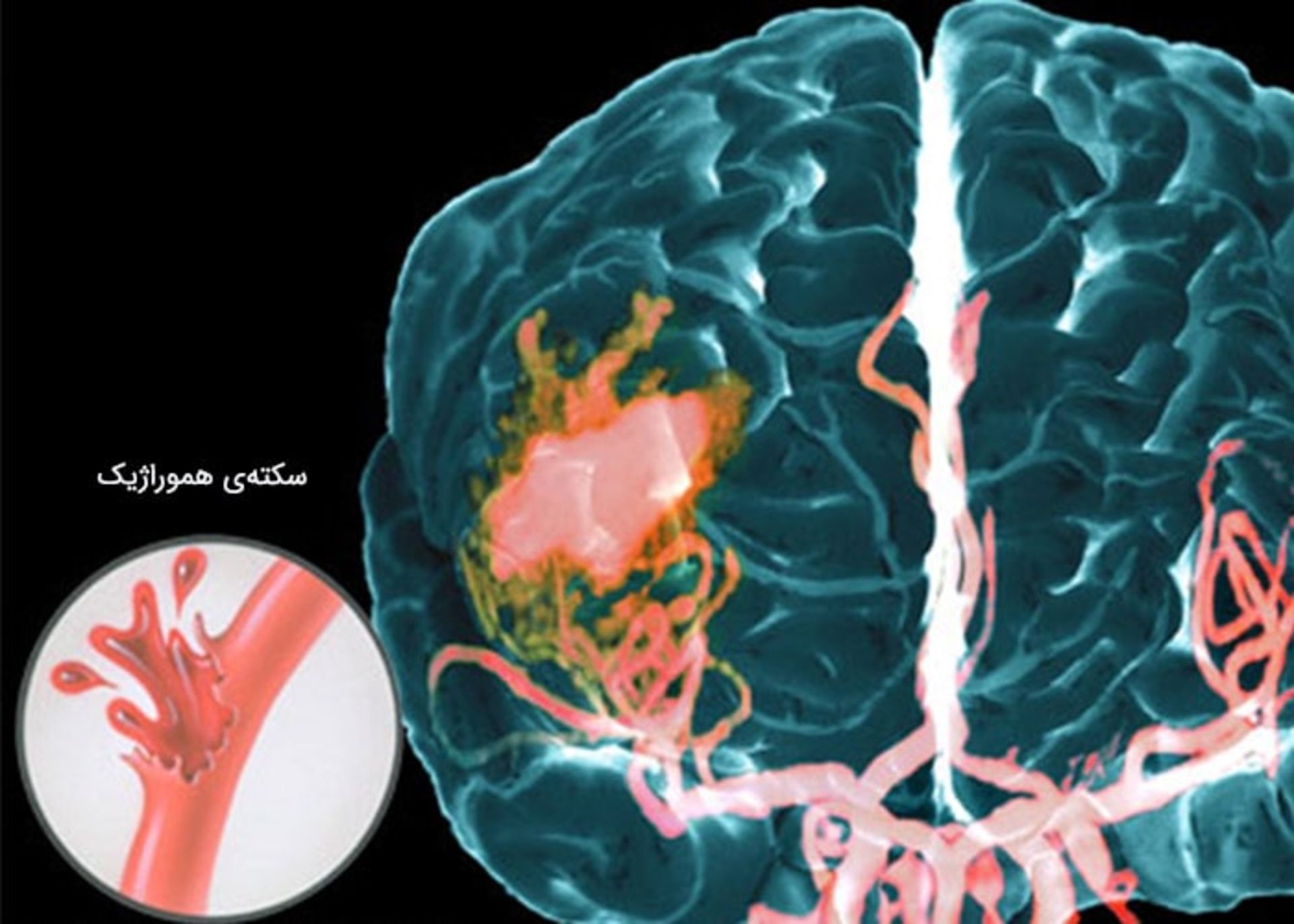 سکته هموراژیک