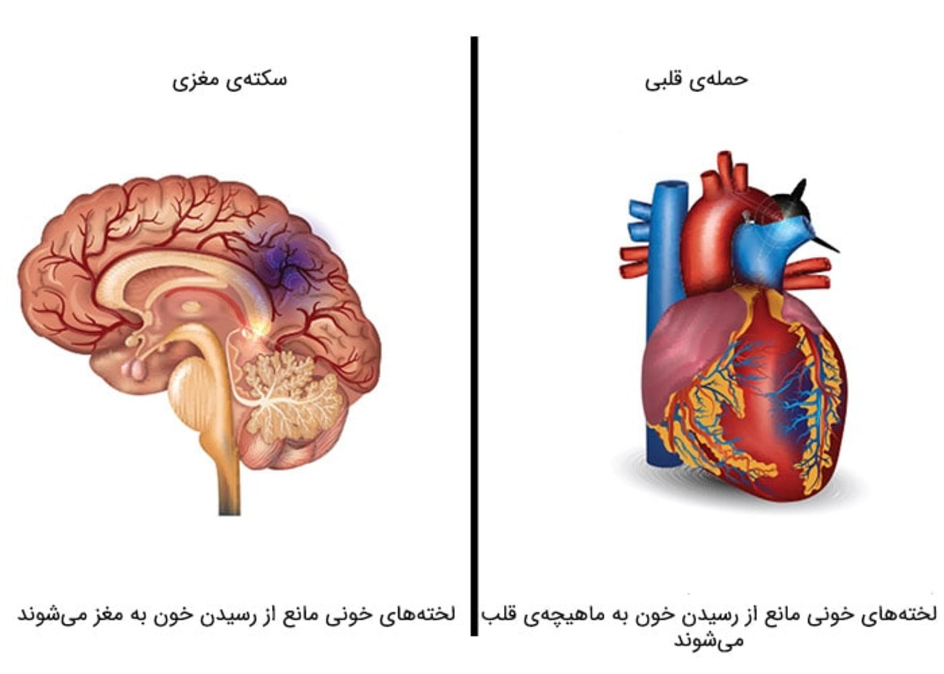 سکته مغزی و حمله قلبی