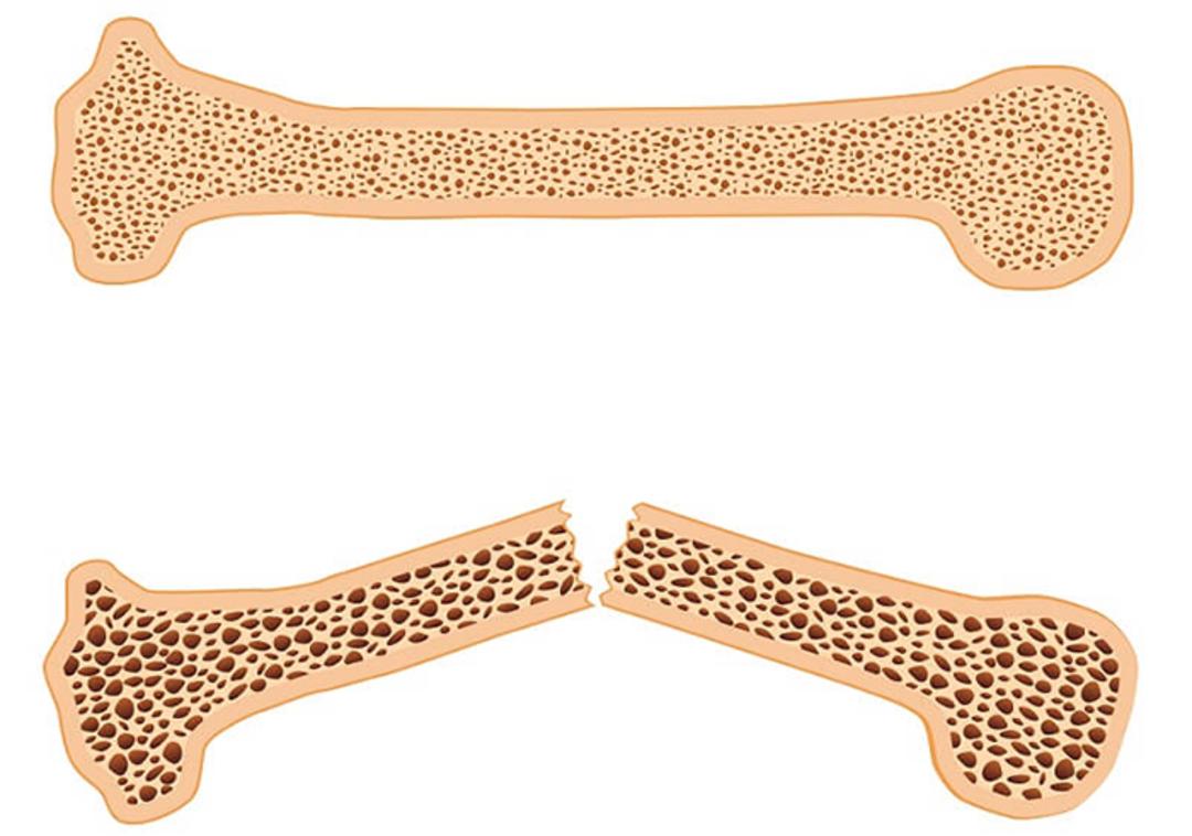 osteoporosis