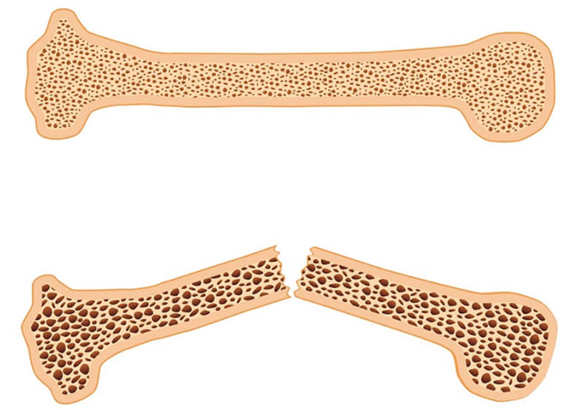 osteoporosis