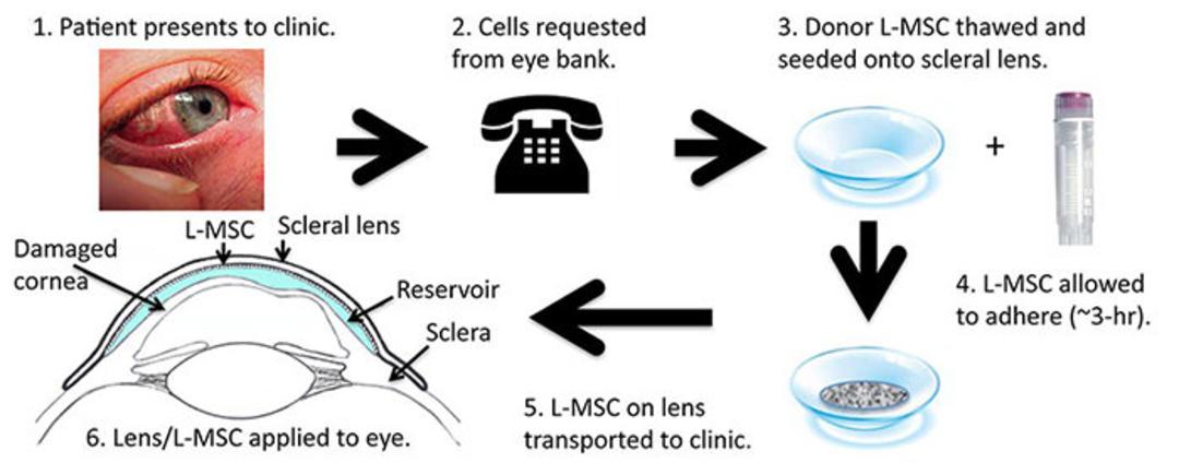 لنز چشم/eye lens