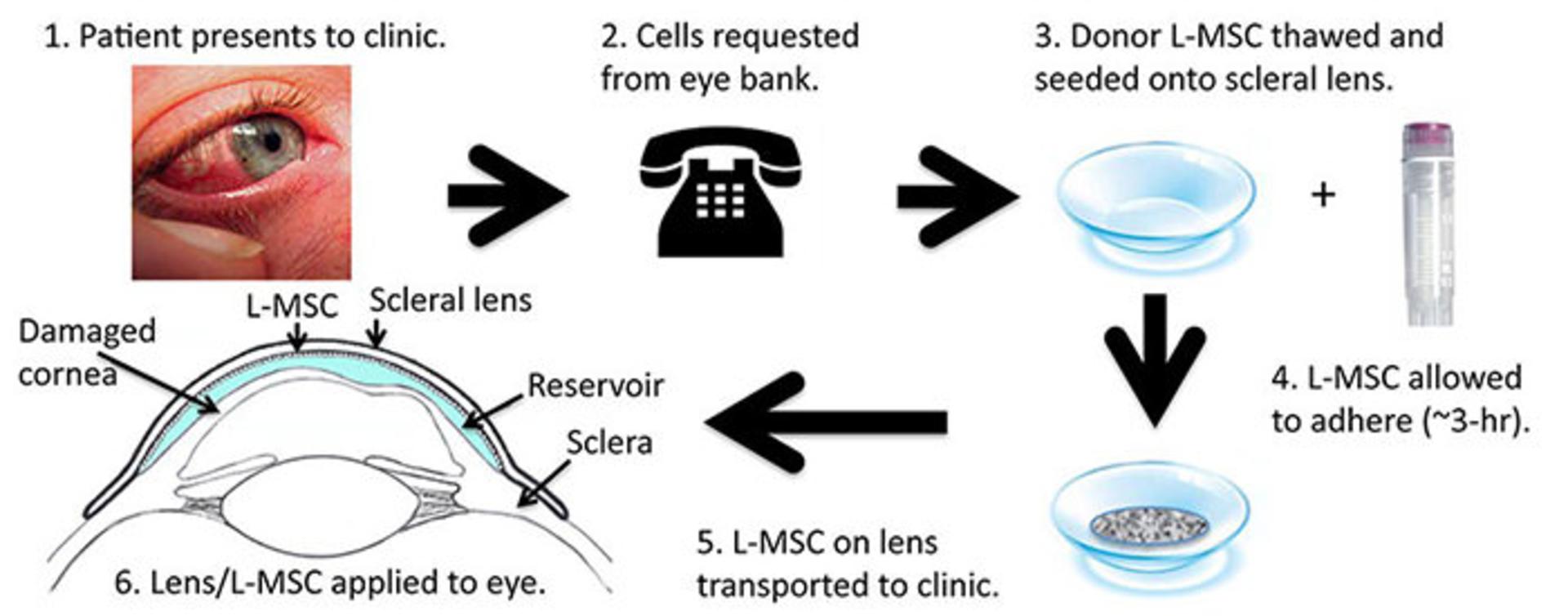 لنز چشم/eye lens