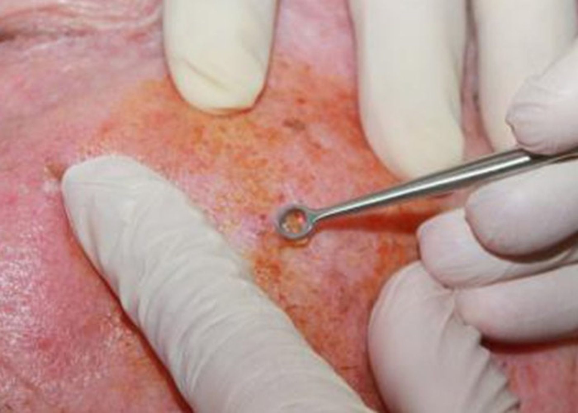 Removal of cancerous tissue