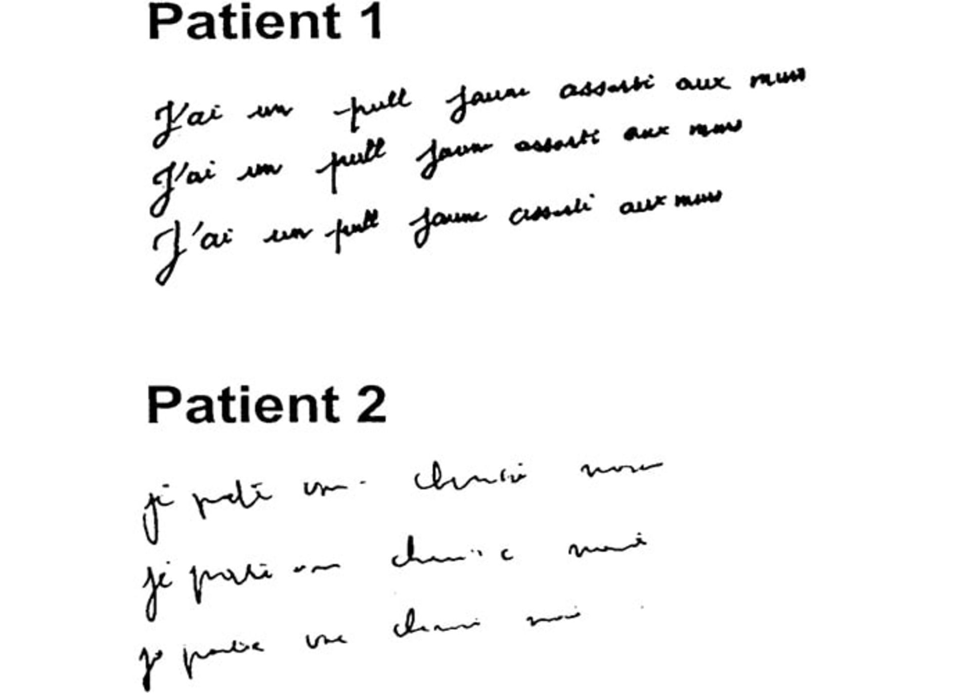 دست خط بیمار مبتلا به پارکینسون