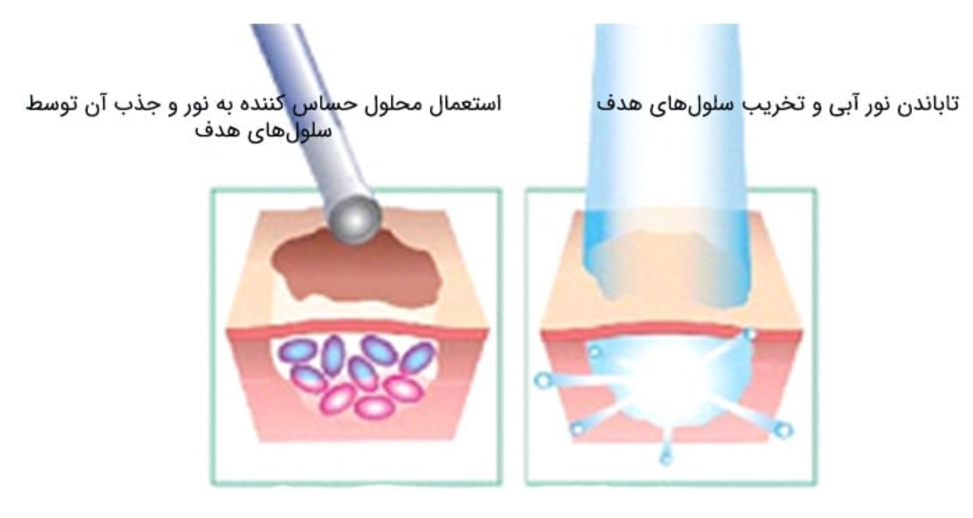 فتودینامیک درمانی سرطان پوست