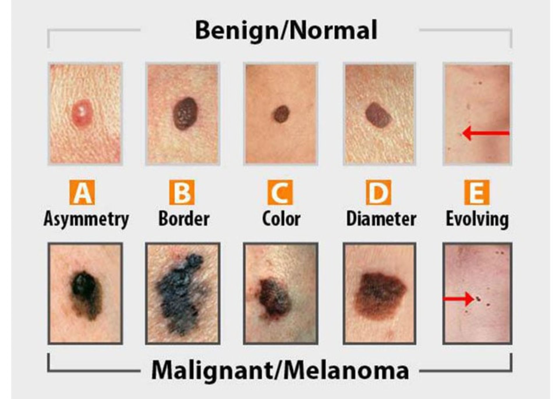 A normal mole compared to a cancerous mole