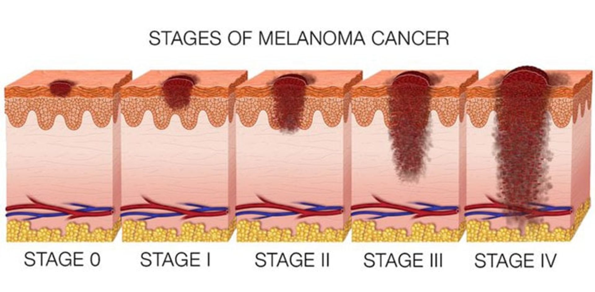 Stages of melanoma