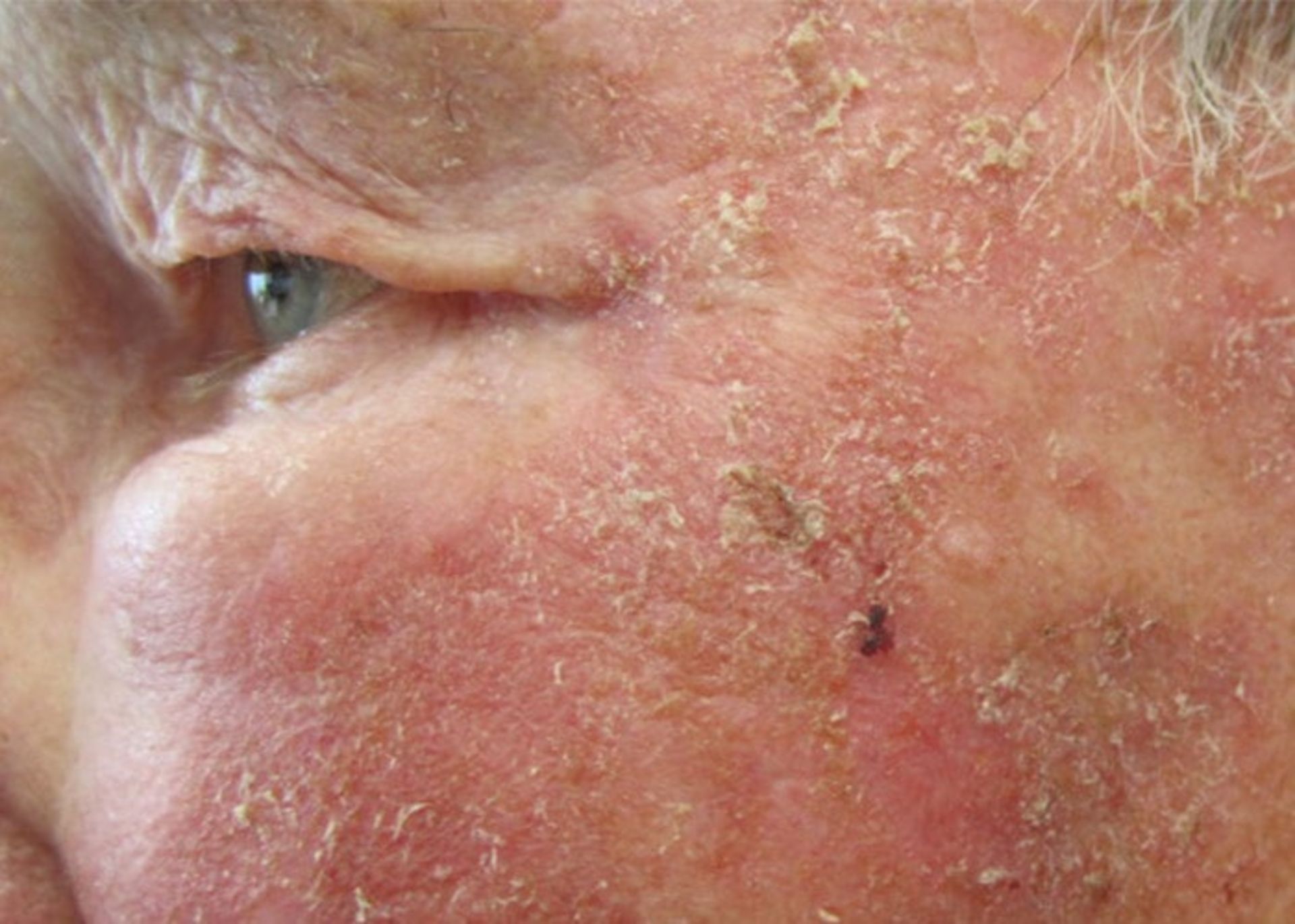 Actinic keratosis