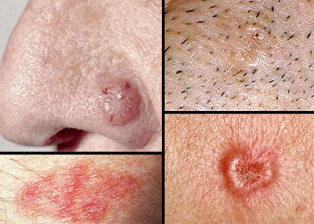 سرطان سلول های قاعده ای