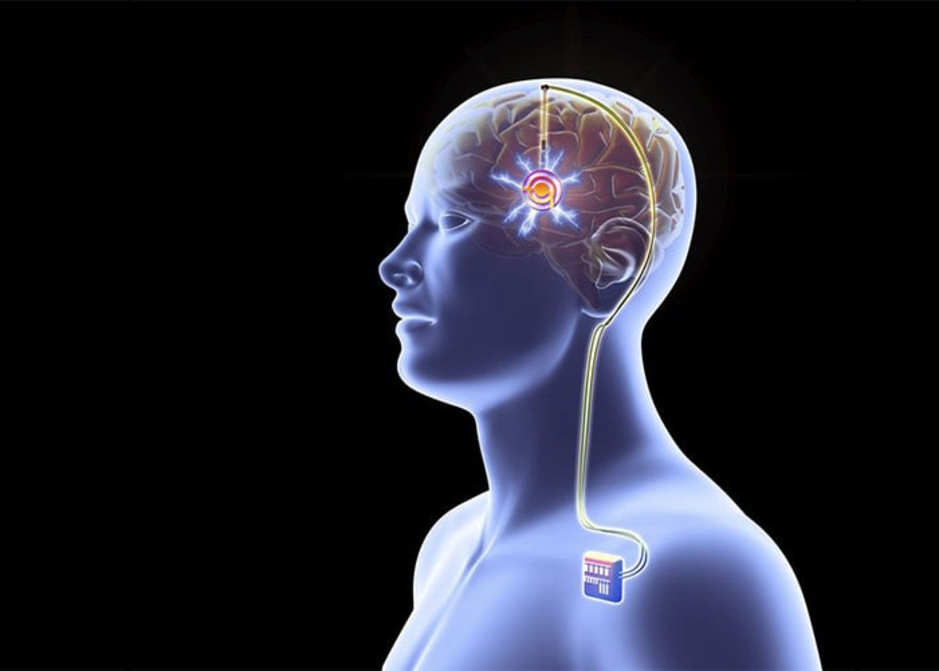 تحریک عمقی مغز برای درمان پارکینسون