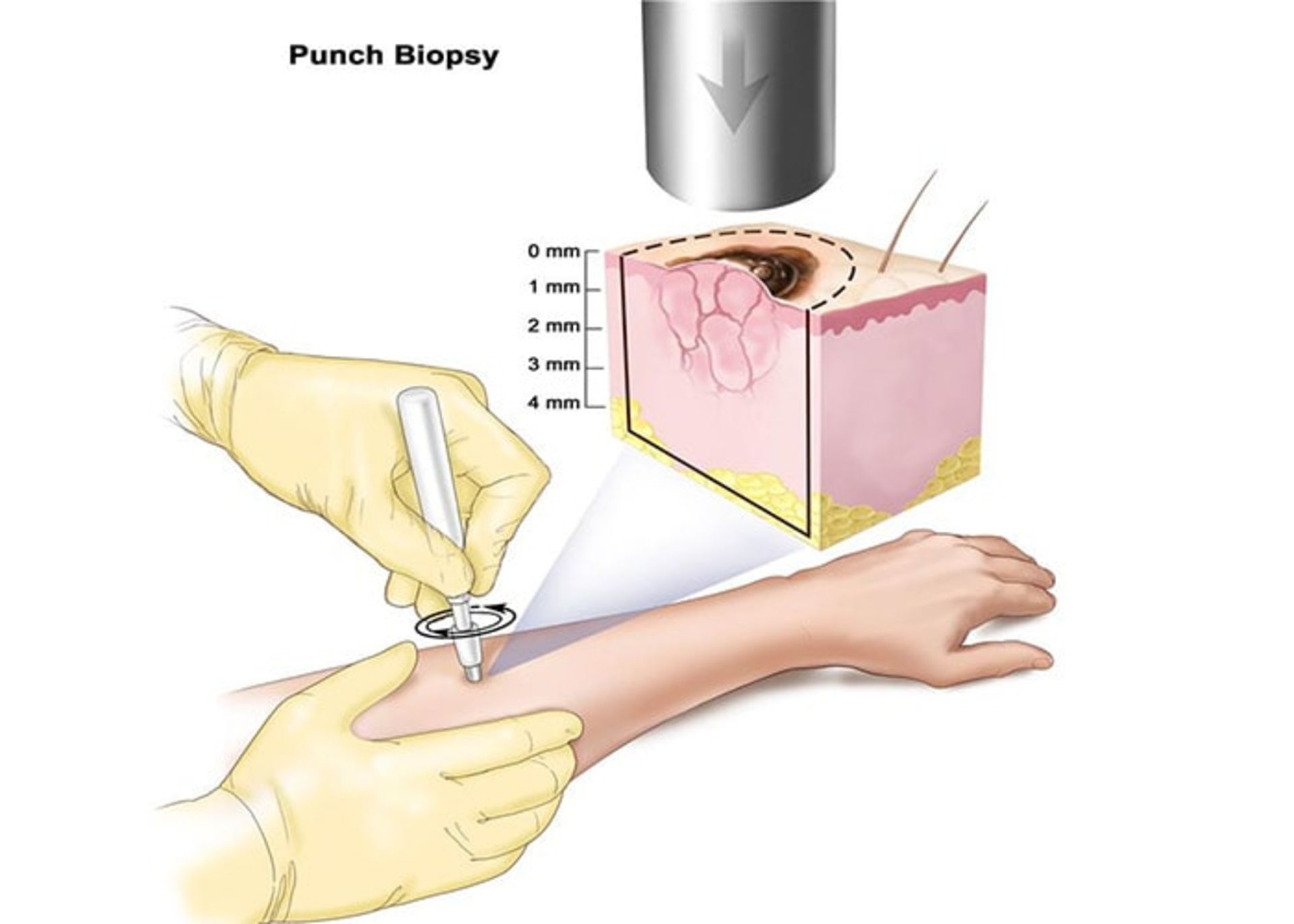 biopsy