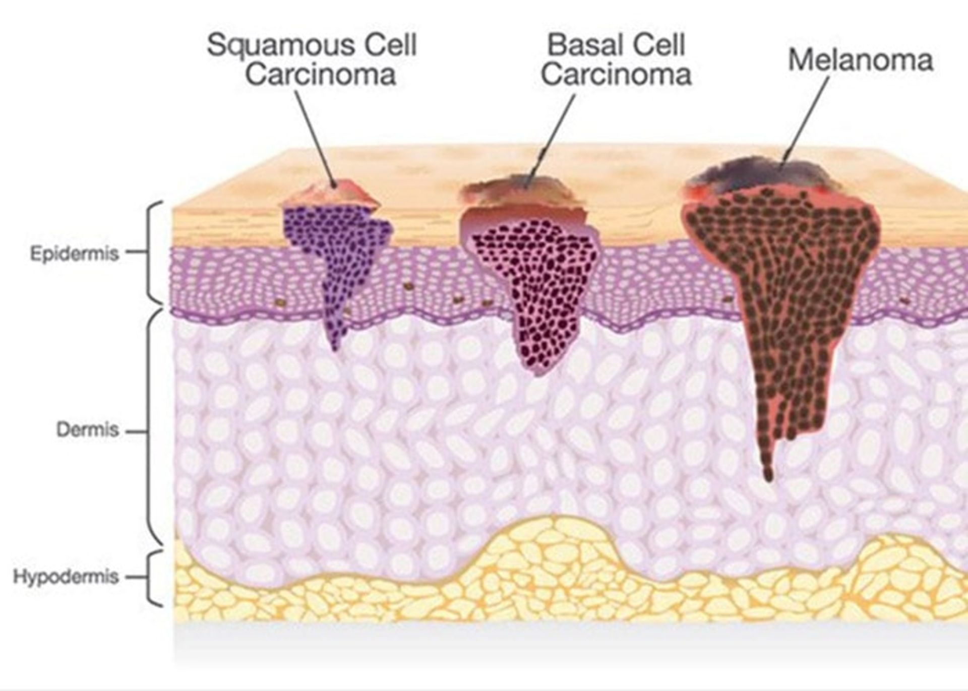 Types of skin cancer