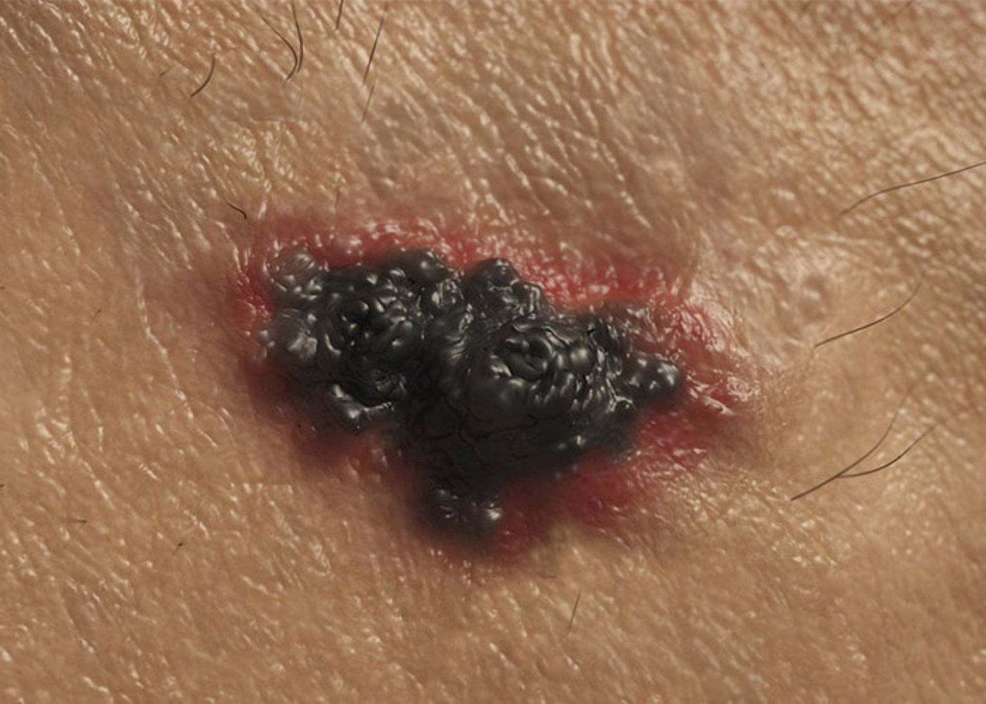 Melanoma