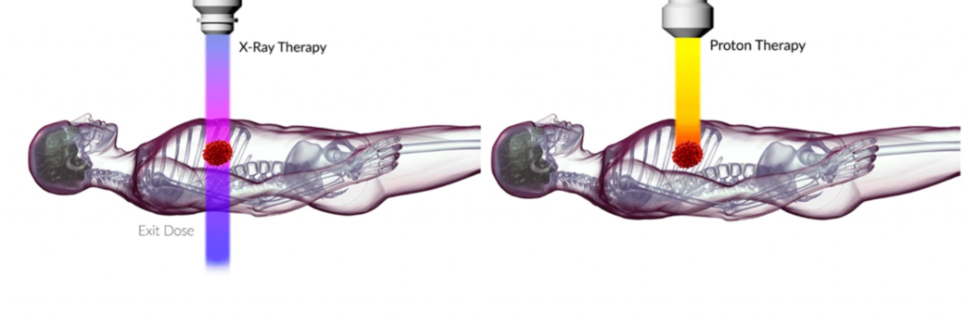 مزیت پروتون‌درمانی نسبت به روشهای رایج پرتودرمانی