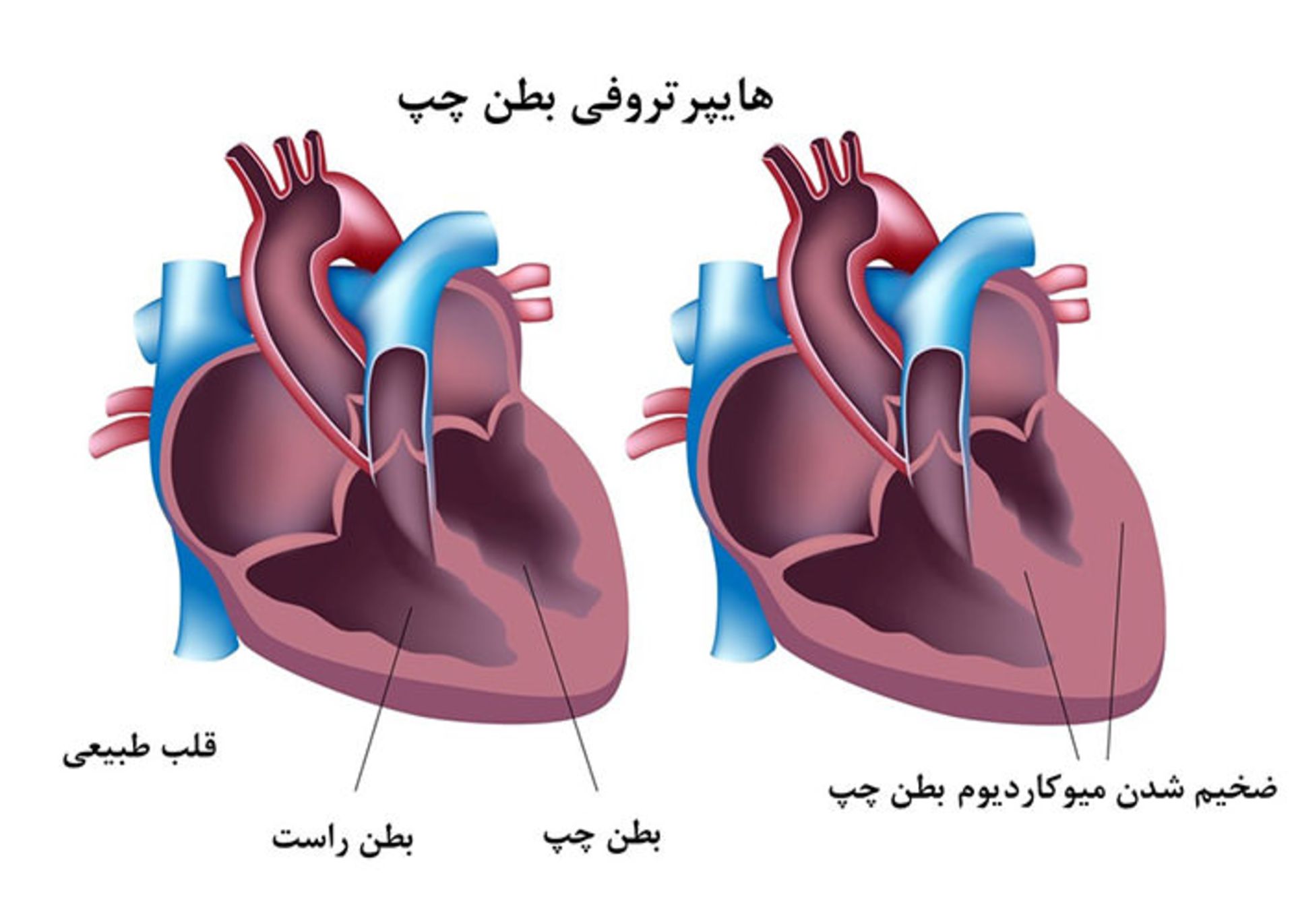 هایپرتروفی قلب