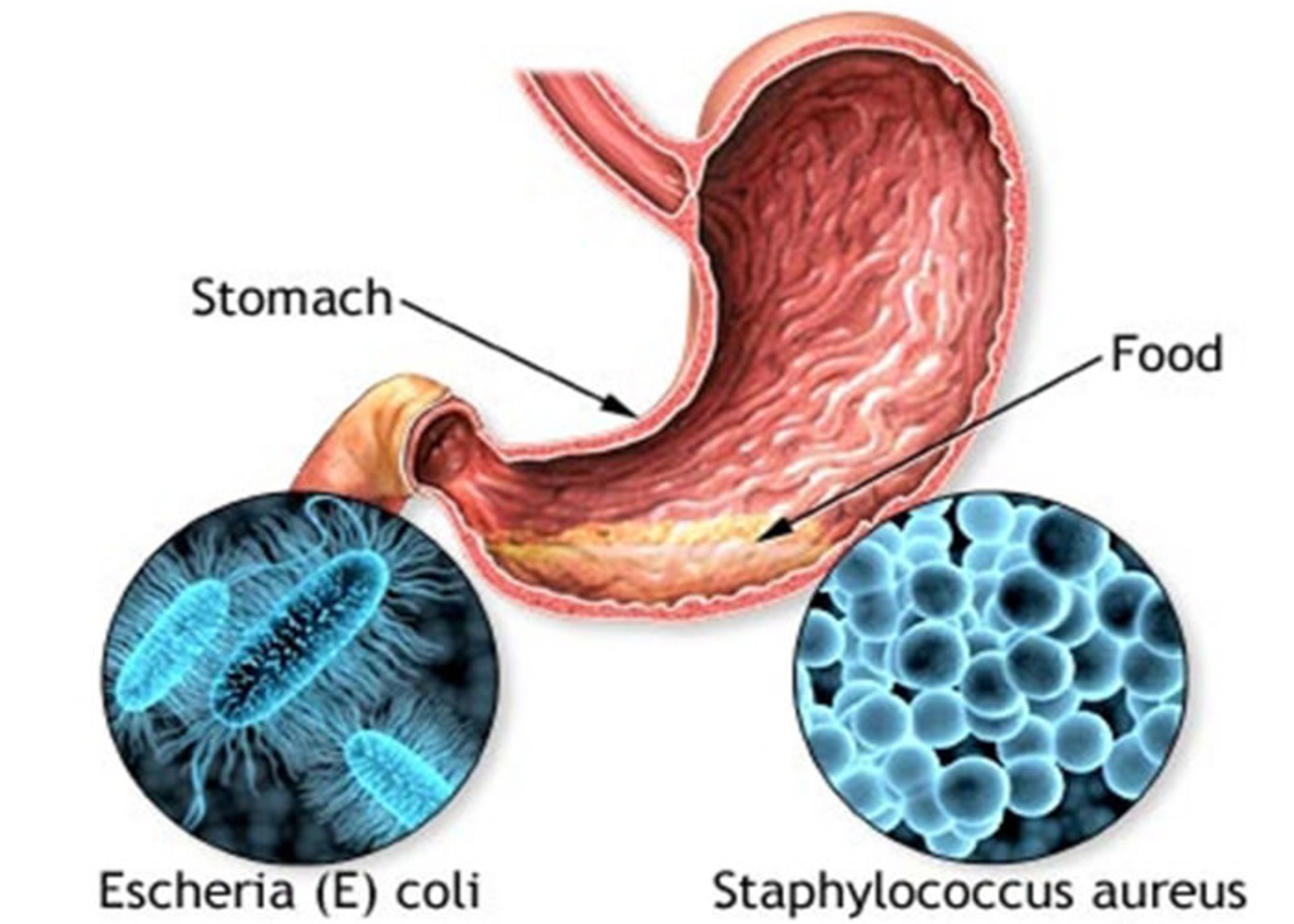 مسمومیت غذایی