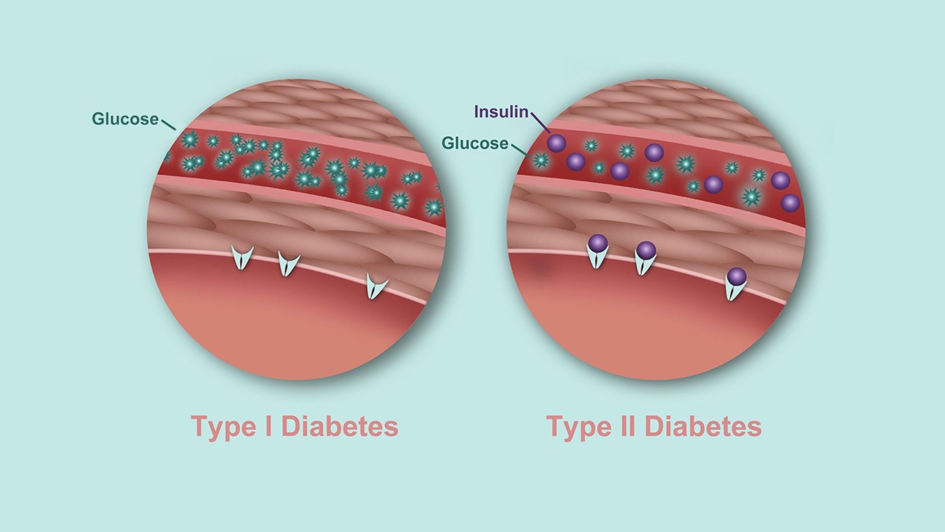 مرجع متخصصين ايران ديابت نوع دو / type 2 diabetes