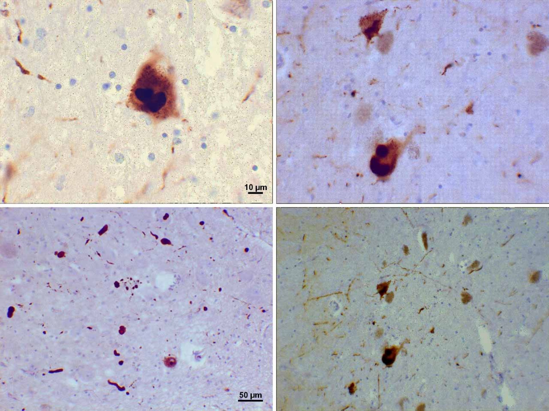  زوال عقل با اجسام لویی / dementia