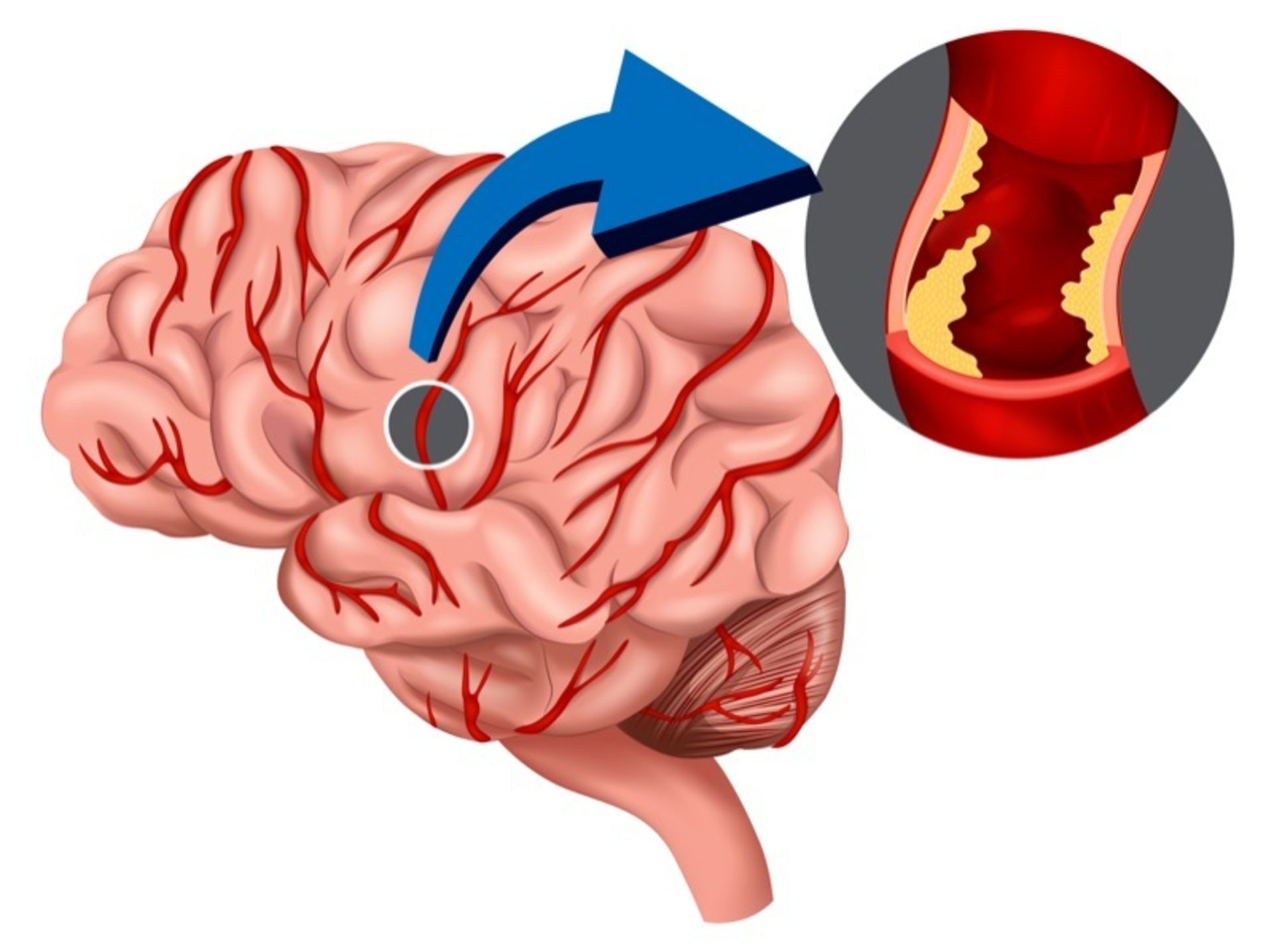 زوال عقل عروقی / vascular dementia