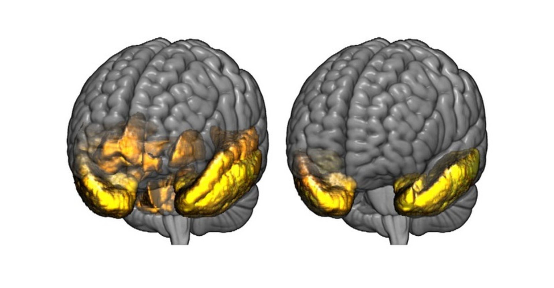 تاثیر آلزایمر روی مغز / dementia