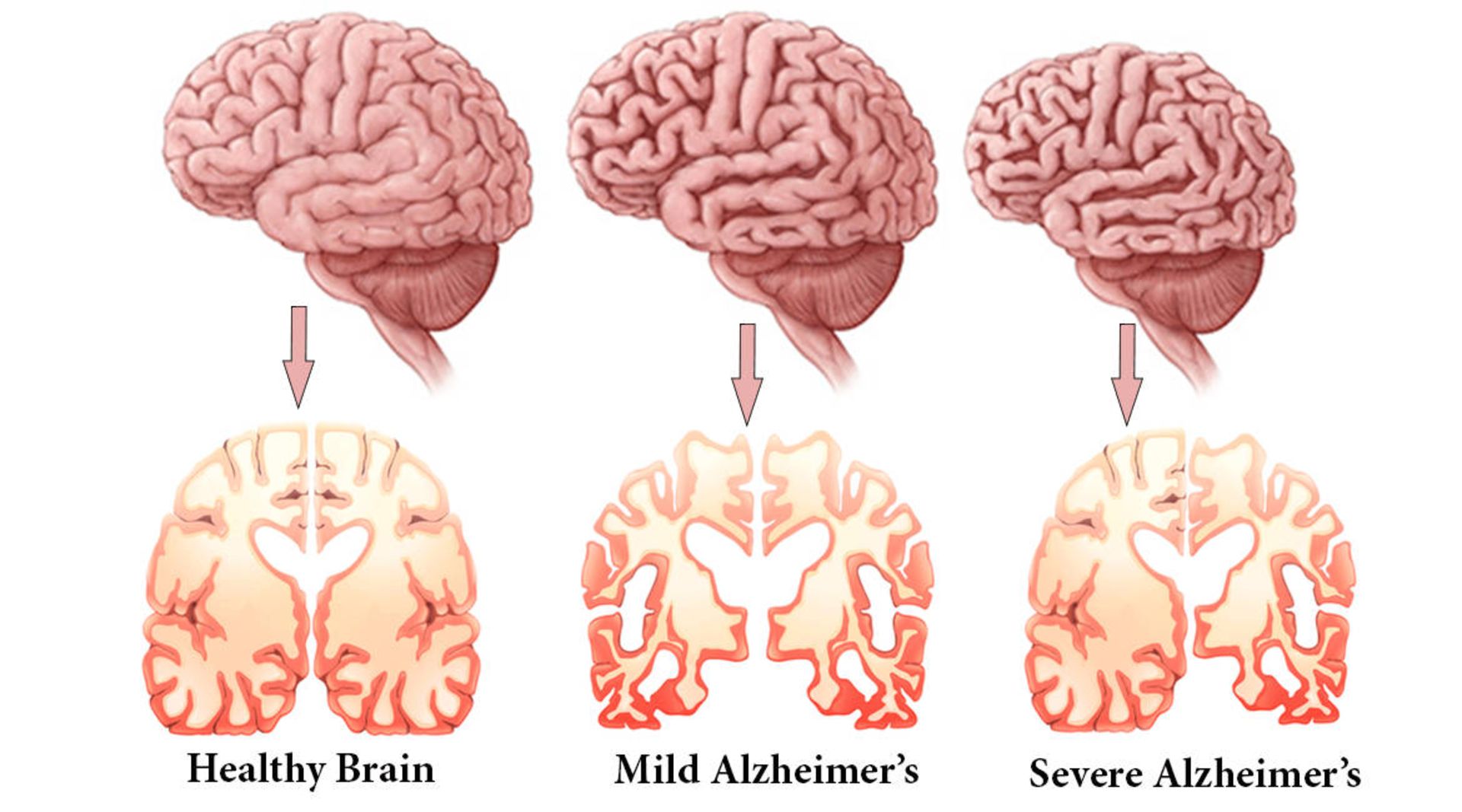 تاثیر آلزایمر روی مغز در مراحل مختلف بیماری / Alzheimer